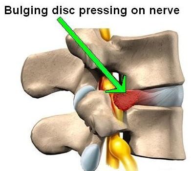 Herniated disc